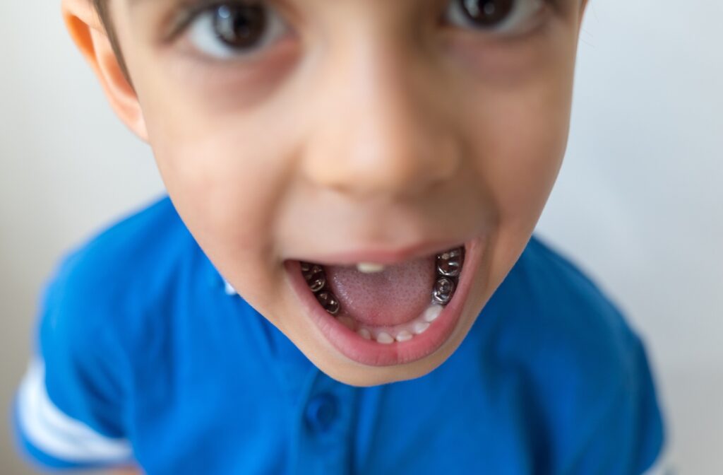 Child with mouth open, showing silver caps on back teeth and molars.