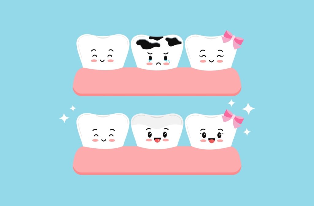 Cartoon illustration of smiling teeth showing before-and-after cavity prevention, with happy teeth after dental sealants.