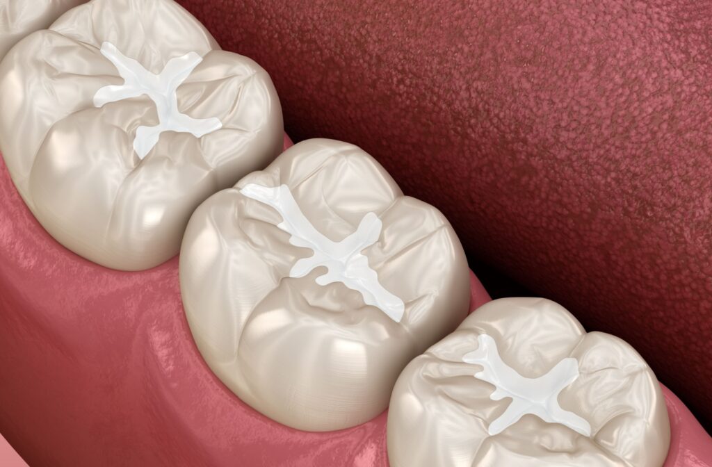 3D illustration showing dental sealants applied to the chewing surfaces of back molars to protect against cavities.