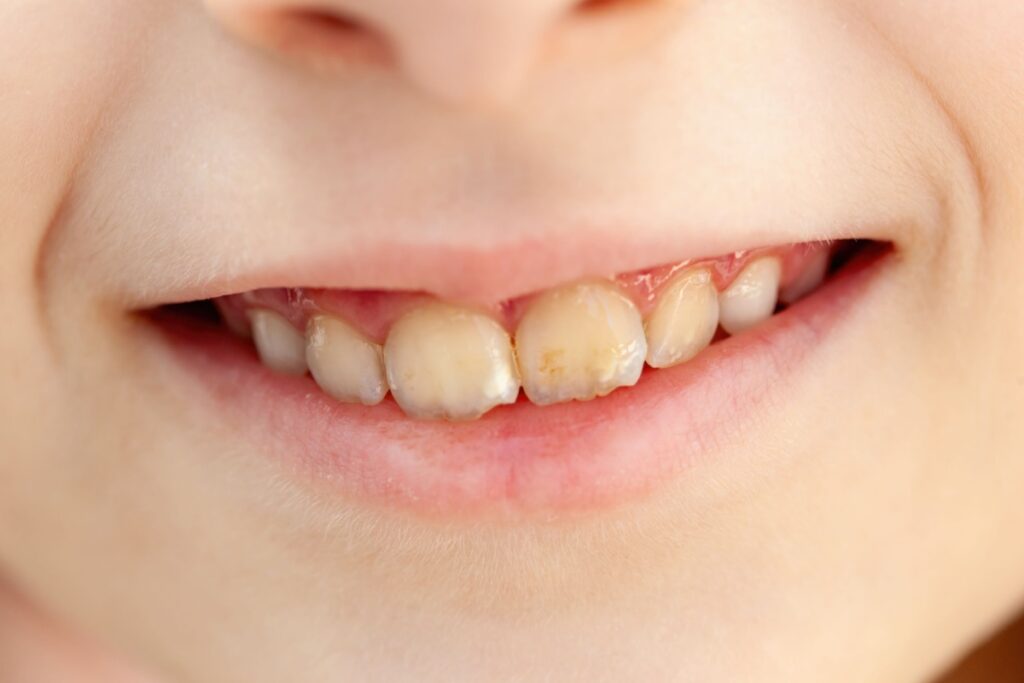 Close-up of a child smiling and showing yellow or stained baby teeth.